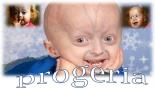 Progeria :...