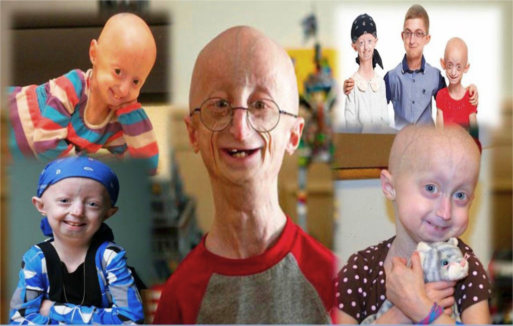 Progeria An Extremely Rare Genetic Aging Disorder